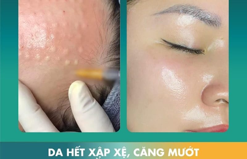 Cải thiện tình trạng da bị lão hoá, xập xệ khi cấy meso extra 