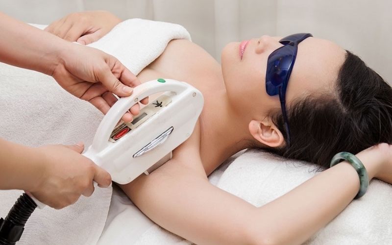 Triệt lông nách bằng phương pháp laser