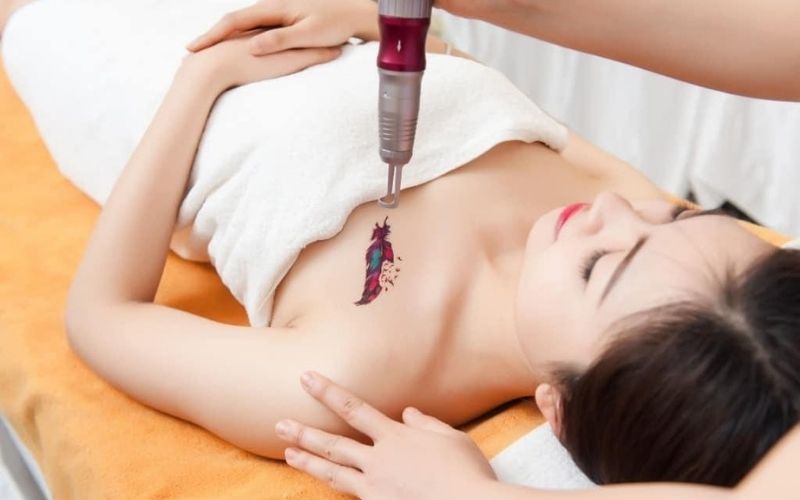 Xoá xăm bằng phương pháp laser an toàn, hiệu quả cao